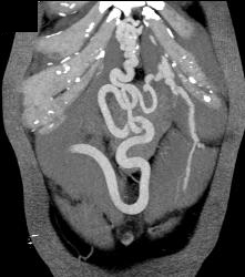 Cirrhosis With Varices - CTisus CT Scan