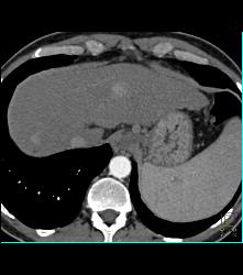 Hepatocellular Carcinoma (Hepatoma) (HCC) - CTisus CT Scan