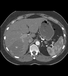 Hemangioma in A Full Sequence of Phases - CTisus CT Scan