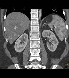 Hemangioma in A Full Sequence of Phases - CTisus CT Scan