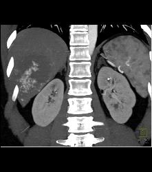 Hemangioma in A Full Sequence of Phases - CTisus CT Scan