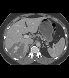 Hemangioma in A Full Sequence of Phases - CTisus CT Scan