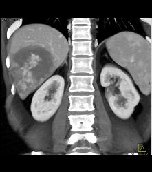 Hemangioma in A Full Sequence of Phases - CTisus CT Scan