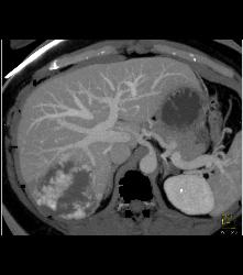 Hemangioma in A Full Sequence of Phases - CTisus CT Scan