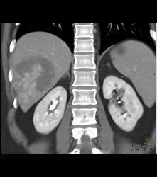 Hemangioma in A Full Sequence of Phases - CTisus CT Scan