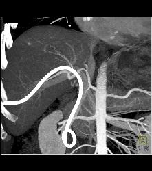 Stent in Common Bile Duct (CBD) With Tumor in Duct - CTisus CT Scan