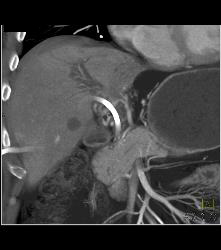 Stent in Common Bile Duct (CBD) With Tumor in Duct - CTisus CT Scan