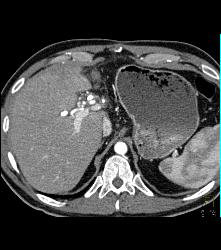 Stent in Common Bile Duct (CBD) With Tumor in Duct - CTisus CT Scan