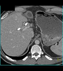 Stent in Common Bile Duct (CBD) With Tumor in Duct - CTisus CT Scan