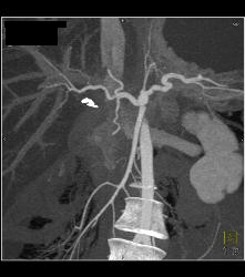 Stent in Common Bile Duct (CBD) With Tumor in Duct - CTisus CT Scan