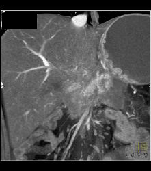 Tumor Infiltrates the Portal Vein - CTisus CT Scan