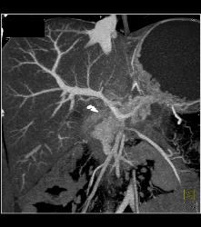 Tumor Infiltrates the Portal Vein - CTisus CT Scan