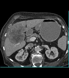 Hepatocellular Carcinoma (Hepatoma) - CTisus CT Scan