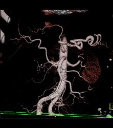 Hepatocellular Carcinoma (Hepatoma) - CTisus CT Scan