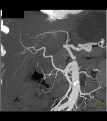 Hepatocellular Carcinoma (Hepatoma) - CTisus CT Scan