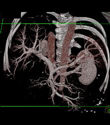 Normal Hepatic Vein - CTisus CT Scan