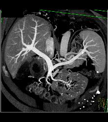 Normal Hepatic Vein - CTisus CT Scan