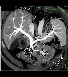 Normal Hepatic Vein - CTisus CT Scan