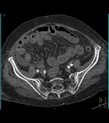 Stent in Common Bile Duct (CBD) and Cholangiocarcinoma With Nodes - CTisus CT Scan