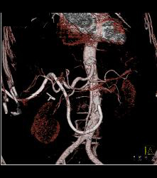 Stent in Common Bile Duct (CBD) and Cholangiocarcinoma With Nodes - CTisus CT Scan