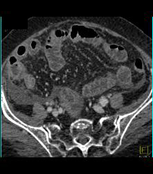 Stent in Common Bile Duct (CBD) and Cholangiocarcinoma With Nodes - CTisus CT Scan