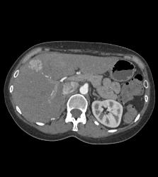 Focal Nodular Hyperplasia (FNH) - CTisus CT Scan