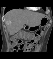 Focal Nodular Hyperplasia (FNH) - CTisus CT Scan