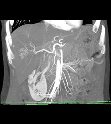 Focal Nodular Hyperplasia (FNH) - CTisus CT Scan