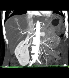 Focal Nodular Hyperplasia (FNH) - CTisus CT Scan