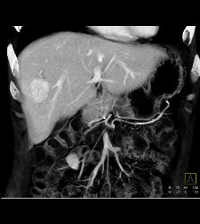 Focal Nodular Hyperplasia (FNH) - CTisus CT Scan