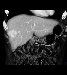 Focal Nodular Hyperplasia (FNH) - CTisus CT Scan