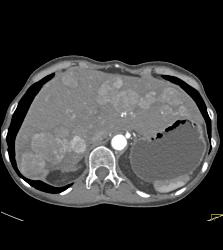 Metastatic Carcinoid Tumor With Liver Metastases and Implants - CTisus CT Scan