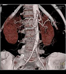 Metastatic Carcinoid Tumor With Liver Metastases and Implants - CTisus CT Scan