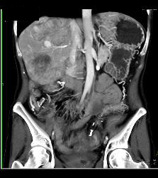 Metastatic Carcinoid Tumor With Liver Metastases and Implants - CTisus CT Scan