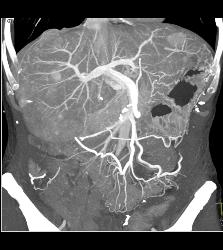 Metastatic Carcinoid Tumor With Liver Metastases and Implants - CTisus CT Scan