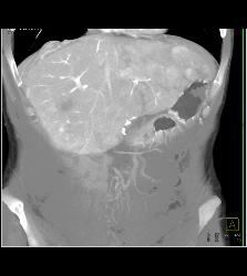 Metastatic Carcinoid Tumor With Liver Metastases and Implants - CTisus CT Scan