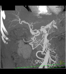 Hepatic and Celiac Artery Aneurysms - CTisus CT Scan