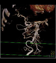 Hepatic and Celiac Artery Aneurysms - CTisus CT Scan