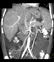 Patchy Enhancement of the Liver - CTisus CT Scan