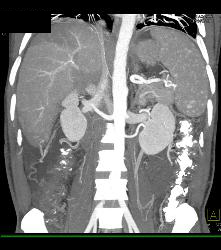 Patchy Enhancement of the Liver - CTisus CT Scan