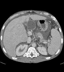 Patchy Enhancement of the Liver - CTisus CT Scan