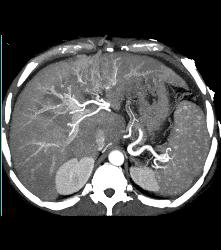 Patchy Enhancement of the Liver - CTisus CT Scan