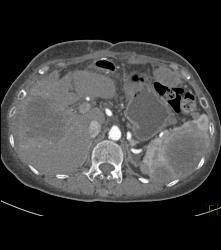 Metastatic Melanoma - CTisus CT Scan