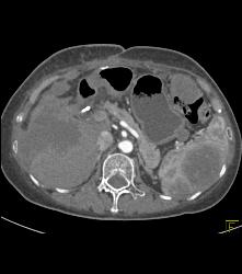 Metastatic Melanoma - CTisus CT Scan