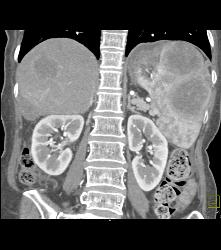 Metastatic Melanoma - CTisus CT Scan