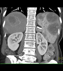 Metastatic Melanoma - CTisus CT Scan