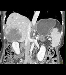 Metastatic Melanoma - CTisus CT Scan