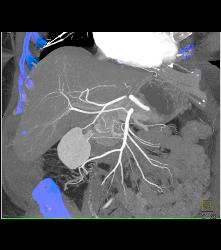 Metastatic Melanoma - CTisus CT Scan