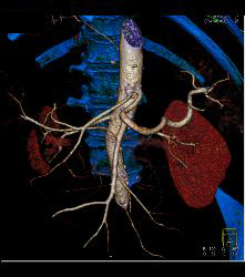 Metastatic Melanoma - CTisus CT Scan