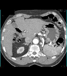 Hepatic Artery Aneurysm - CTisus CT Scan